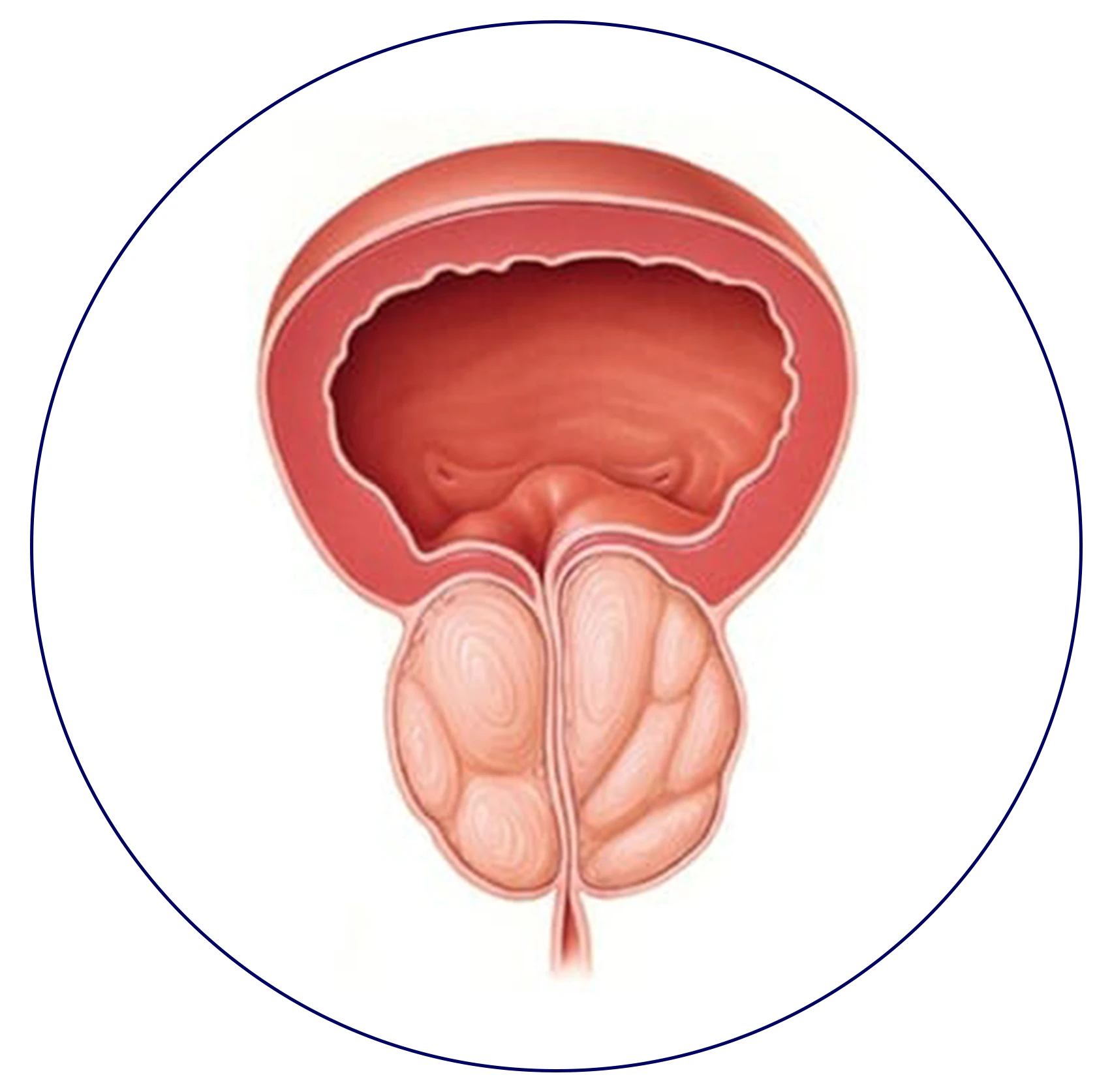 A medical illustration depicting the stages of bladder cancer