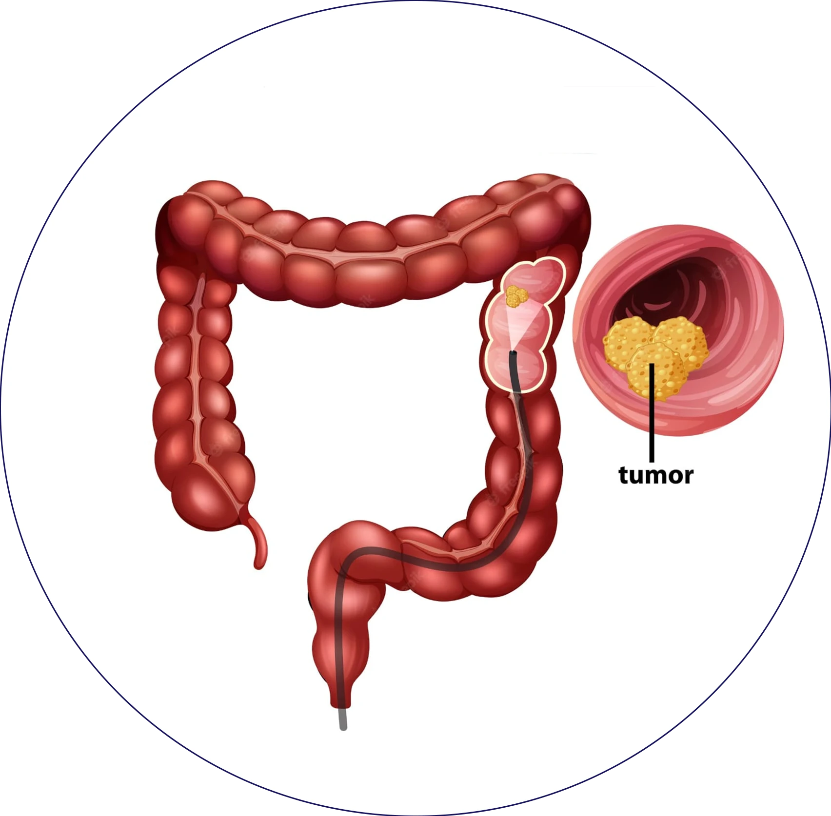 Image of a medical professional specializing in colorectal cancer treatment in Aurangabad