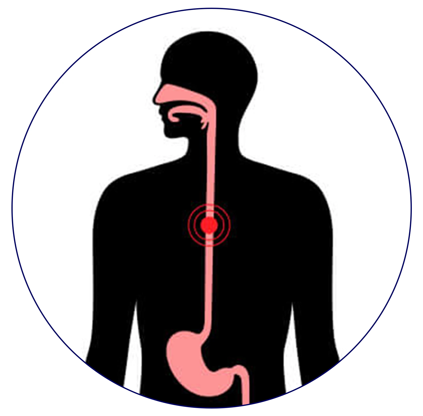 An endoscopic image revealing esophageal cancer.