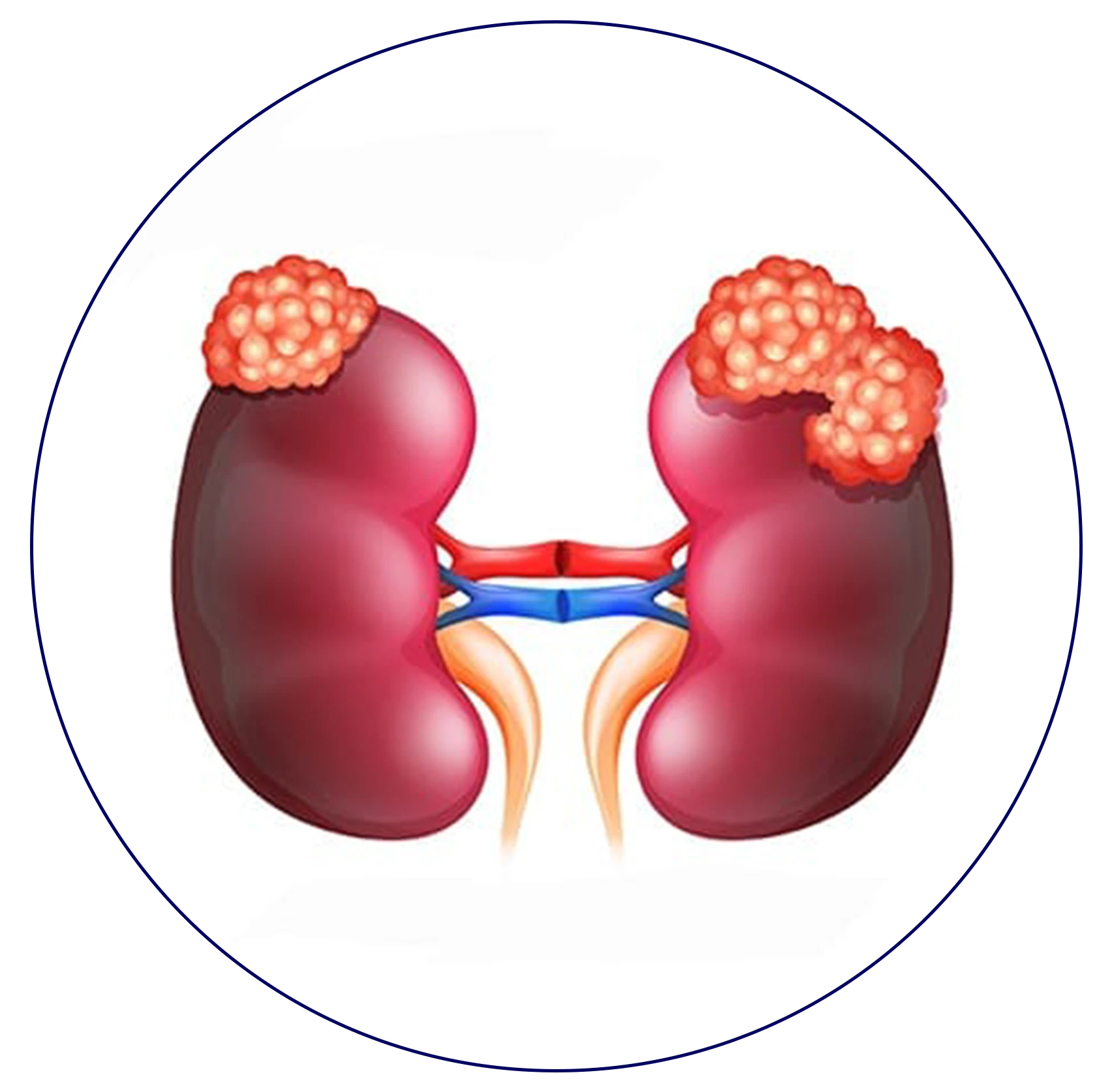 Illustration depicting kidney cancer awareness symbol