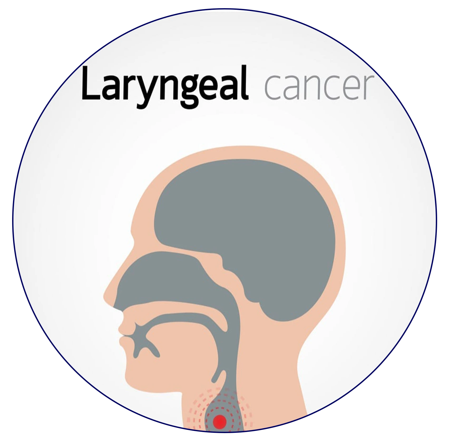 Illustration of Laryngeal Cancer - Anatomy and Disease