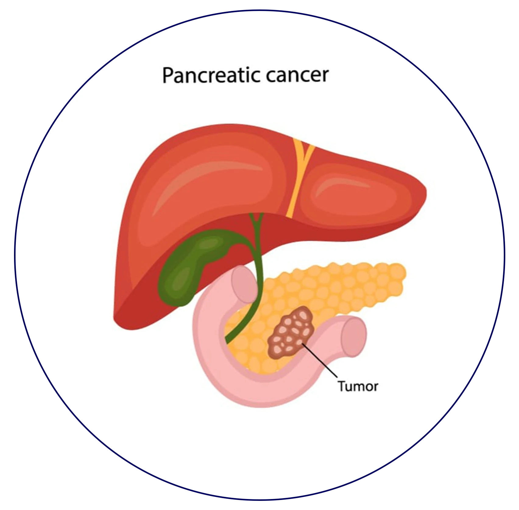 Illustration of Pancreatic Cancer Awareness Ribbon and Cells